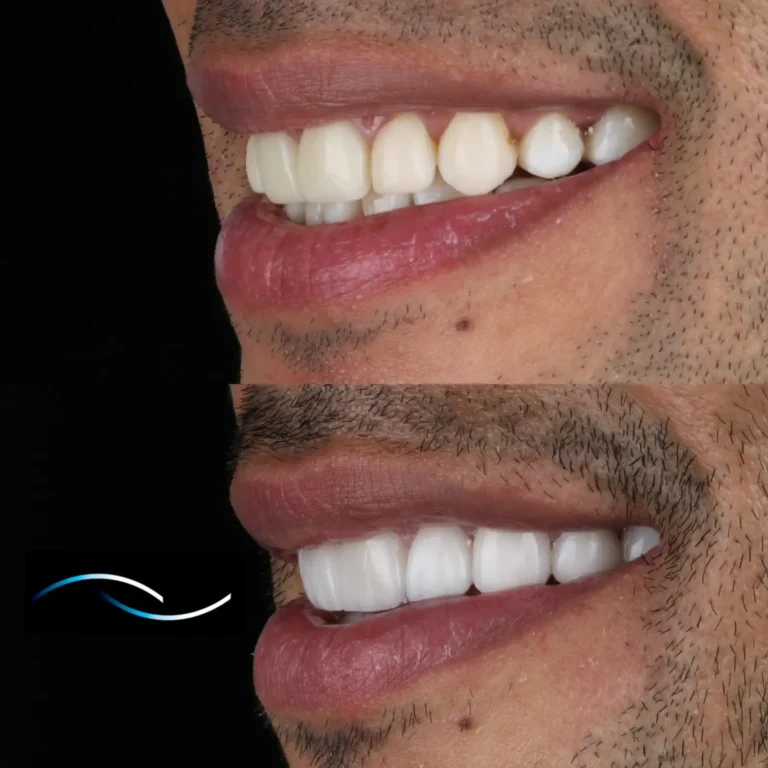 Antes y despues 24