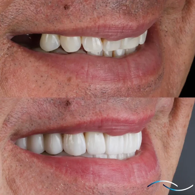 Antes y despues 25