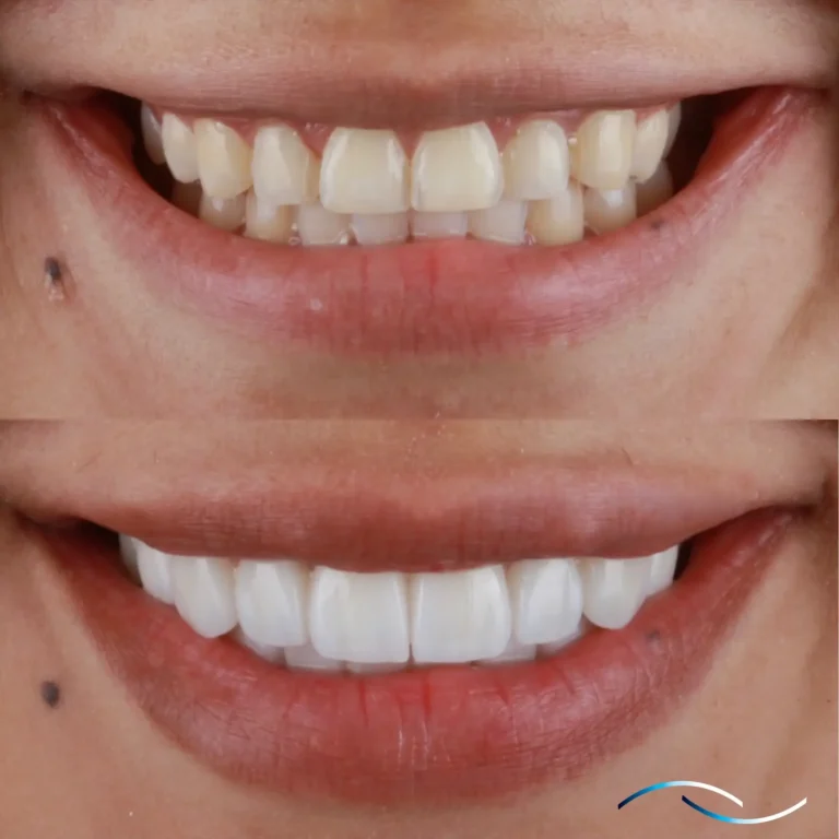 Antes y despues 27