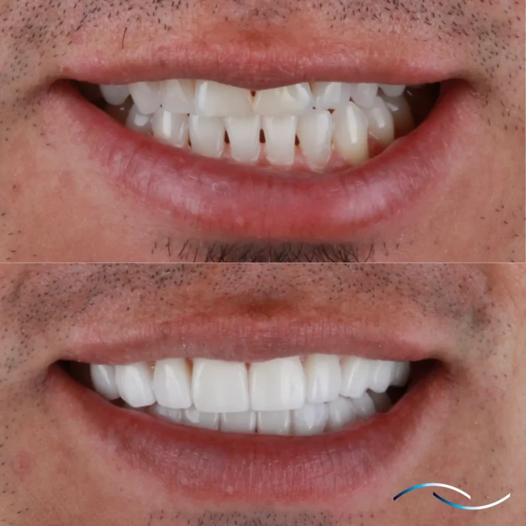 Antes y despues 31