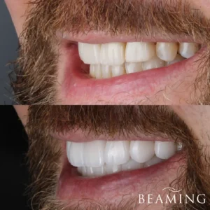 Antes y despues 32