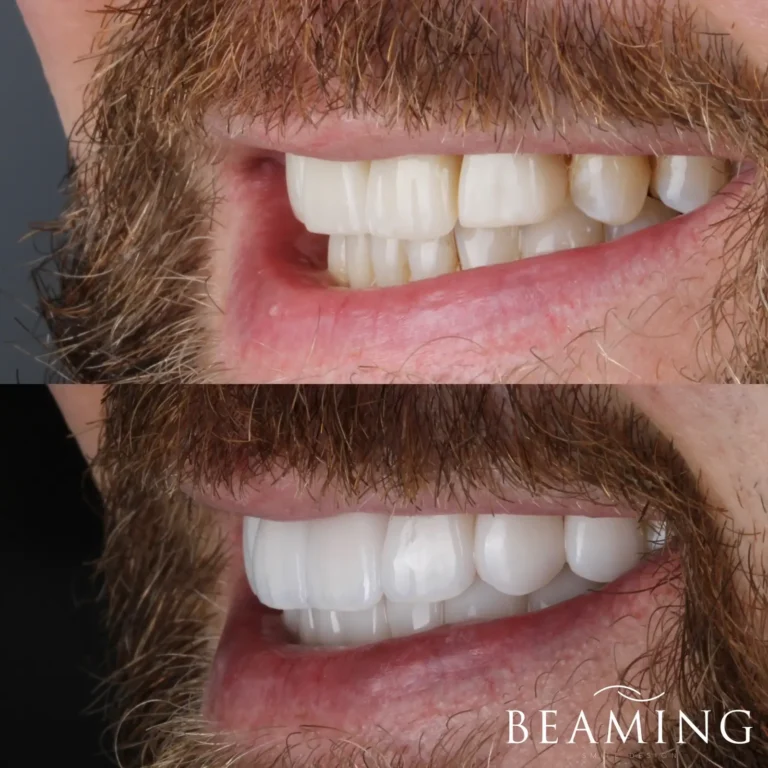 Antes y despues 32