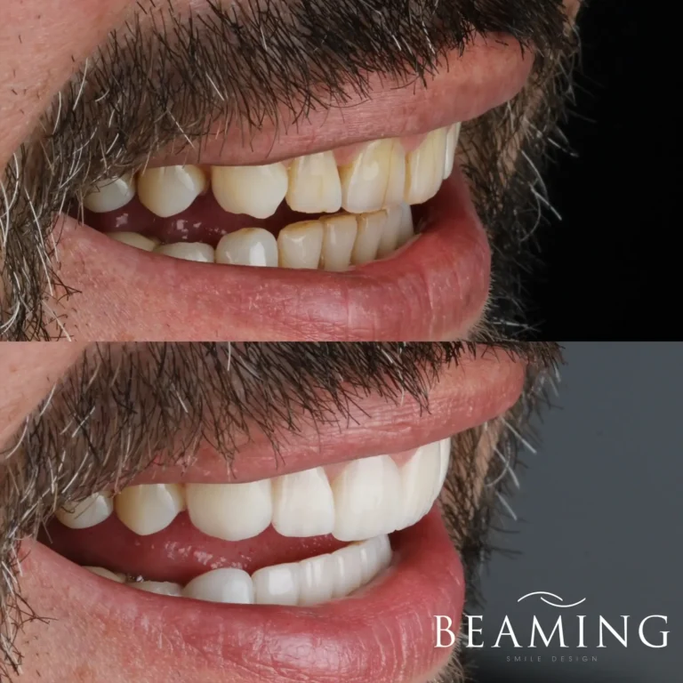 Antes y despues 33