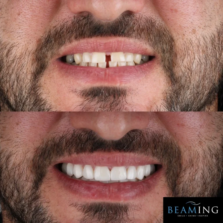 Antes y despues 34