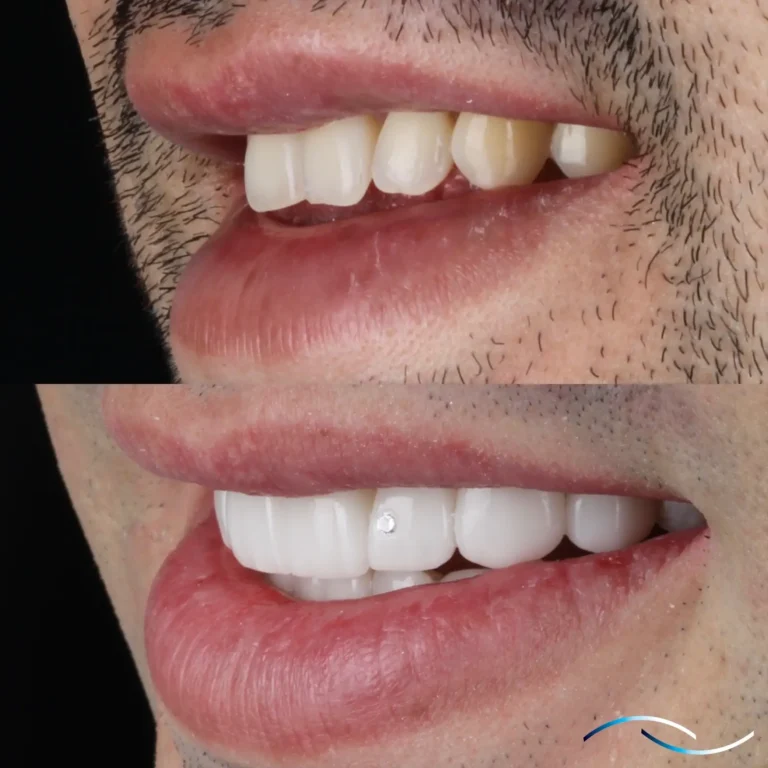 Antes y despues 35
