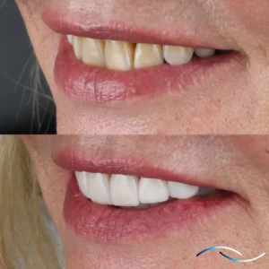 Antes y despues 36
