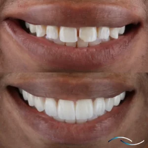 Antes y despues 37