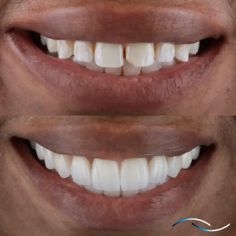 Antes y despues 37