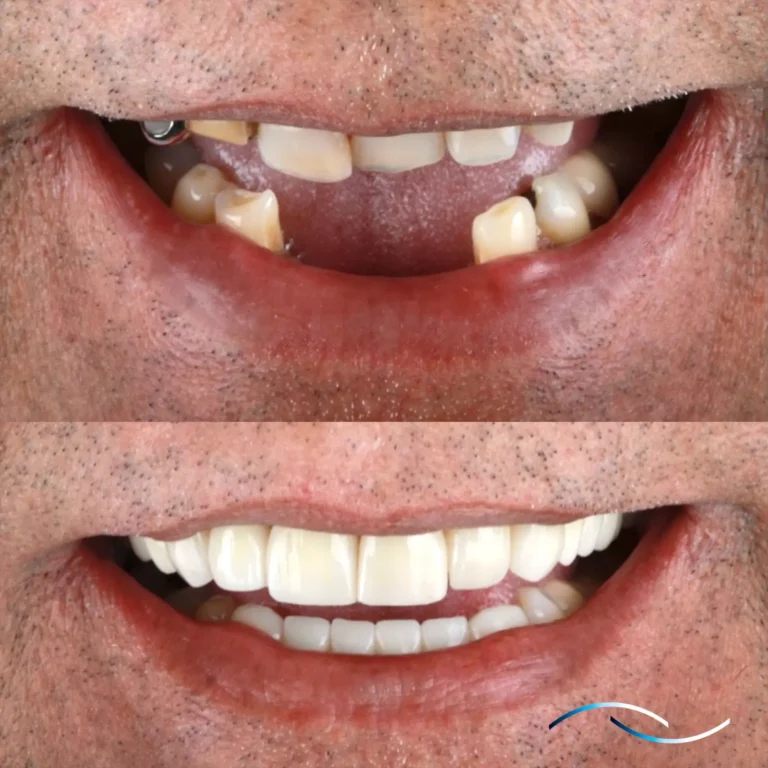 Antes y despues 38