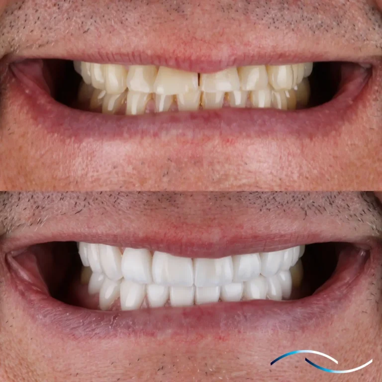 Antes y despues 39