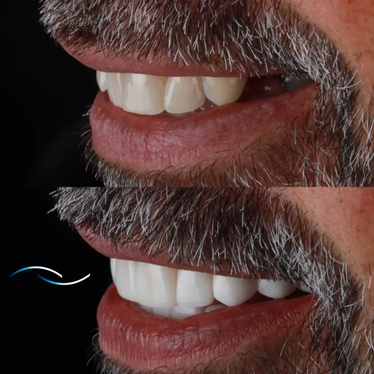 Antes y despues 42