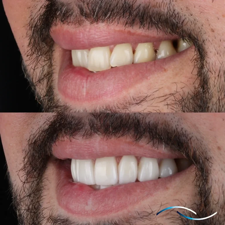 Antes y despues 43