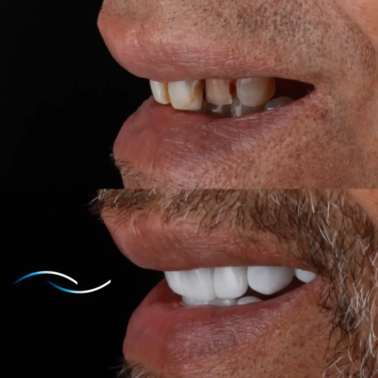 Antes y despues 44