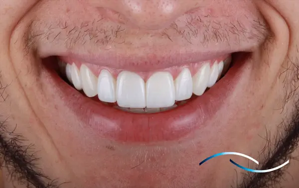 Diseño de sonrisa