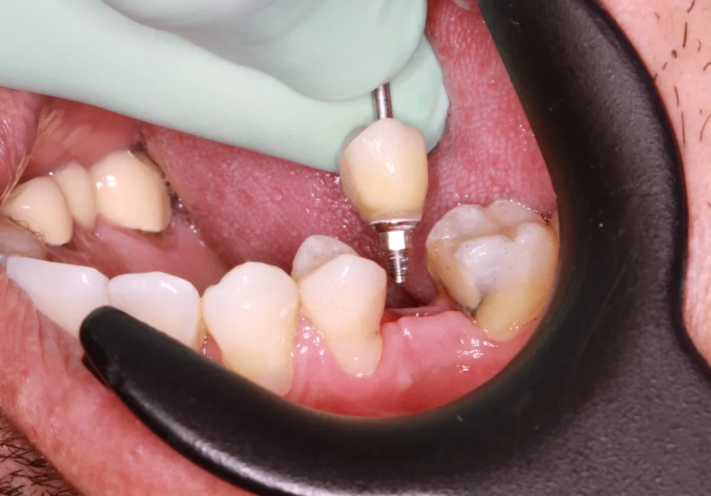 Clínica en Colombia de implantes dentales