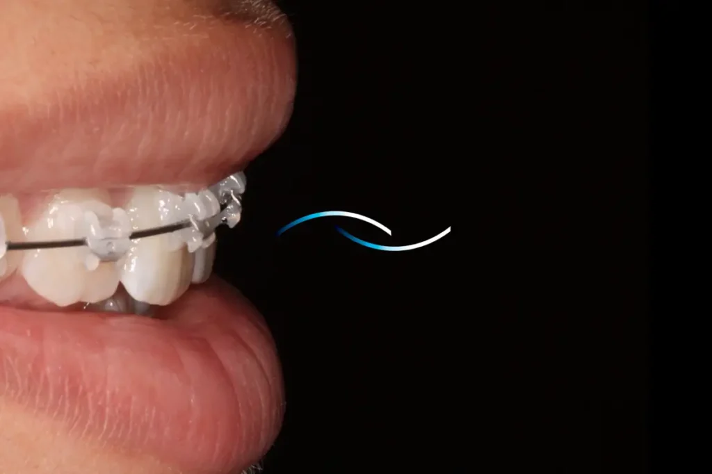 tratamiento de ortodoncia con brakets en Colombia