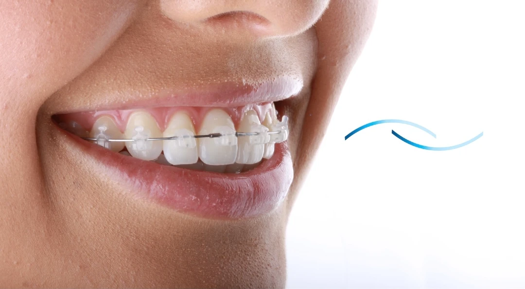 ortodocncia con brakets ref