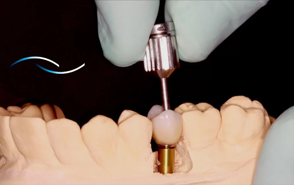precios de implantes dentales en Colombia