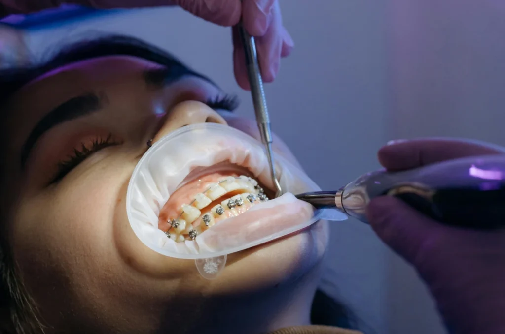 tratamiento con brakets en colombia